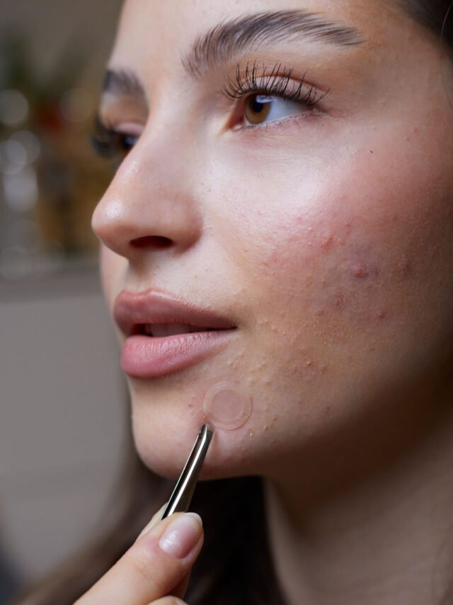 Chin pimples – How to treat and prevent them